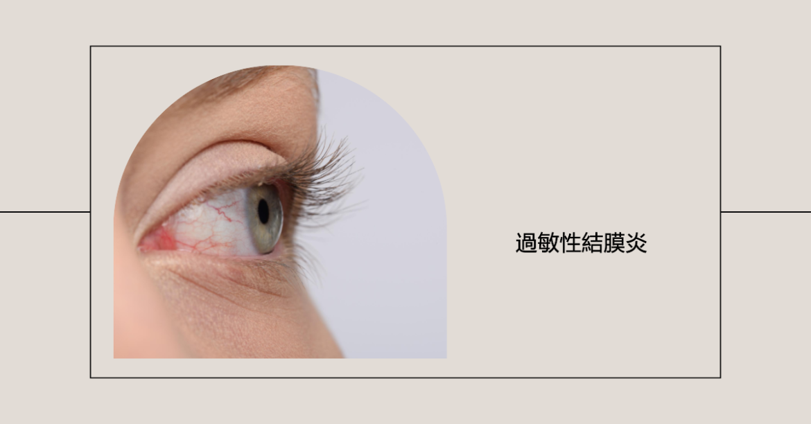 過敏性結膜炎